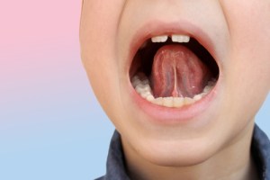 Frenectomy of small boy 