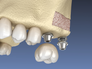 Guided Bone Regeneration and Sinus Augmentation