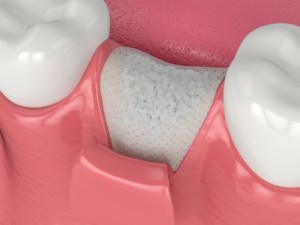 Osseous Surgery and Guided Tissue Regeneration image